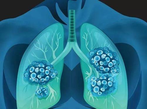 肺癌筛查的扫描可以检测其他与吸烟有关的疾病