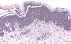 研究发现生物性银屑病治疗的长期持续影响