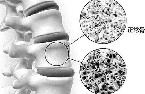 新型药物可显着降低绝经后骨质疏松症妇女的脊柱骨折风险