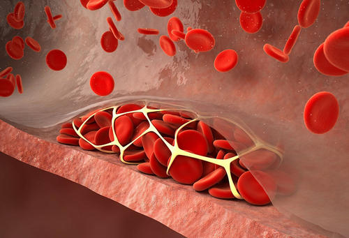 血液中胆固醇偏高不仅易导致心脏血管栓塞 而且会伤害双腿