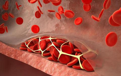 血液中胆固醇偏高不仅易导致心脏血管栓塞 而且会伤害双腿