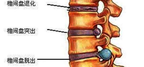 预防椎间盘突出症的装置在挫折后获得PMA