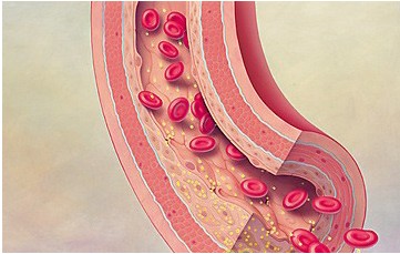 Cardiva的血管闭合系统可以减少患者在研究中的恢复时间