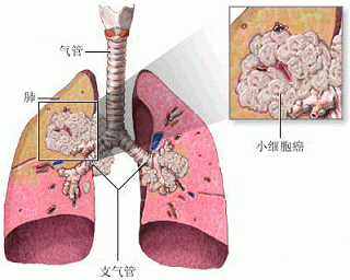研究发现人工智能可以识别图像中的肺癌类型