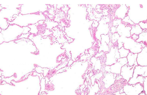 通过黏液摆动的纳米颗粒可能预示着严重的COPD