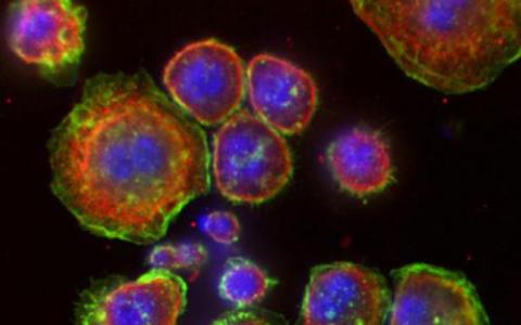 B细胞亚型在黑色素瘤的免疫反应中起重要作用
