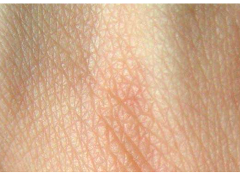 预测皮肤弹性的新方法可以帮助烧伤者长出新皮肤