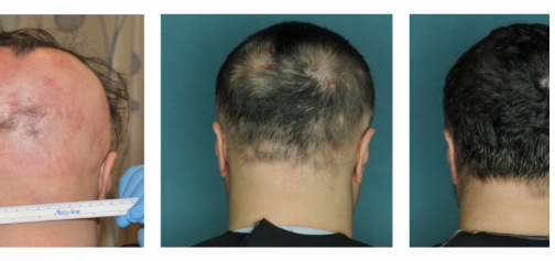 药物可恢复斑秃患者的头发生长