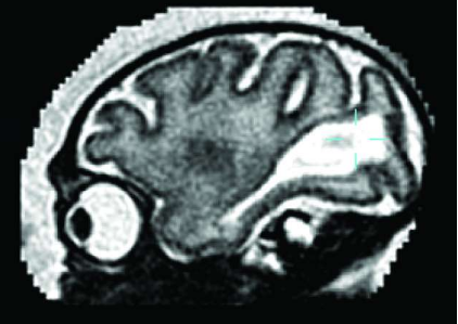 研究细节寨卡病毒在怀孕期间破坏胎儿大脑发育