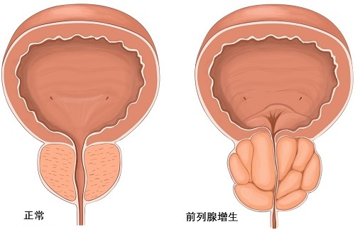 偶然发现促使科学家提出解释良性前列腺增生的机制