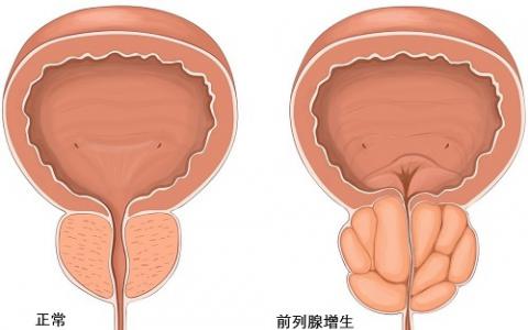 偶然发现促使科学家提出解释良性前列腺增生的机制
