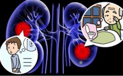 研究人员确定预测和预防捐赠肾脏损害的方法