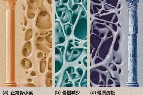 研究调查了英格兰和威尔士与骨质疏松性骨折有关的趋势