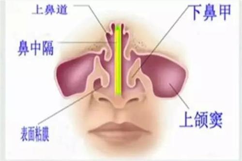 研究小组建议在治疗成人鼻窦炎时共同决策