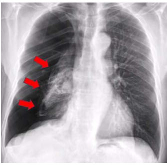 AI系统使用胸部X射线更准确地识别塌陷的肺