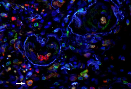 免疫细胞作为特发性肺纤维化的生物标志物