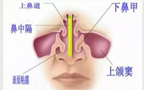 研究小组建议在治疗成人鼻窦炎时共同决策