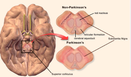 帕金森病在阑尾切除术患者中更普遍
