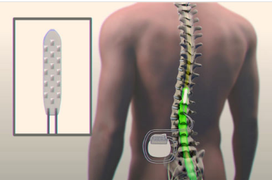 脊柱植入物和物理疗法可帮助瘫痪的人站立和行走