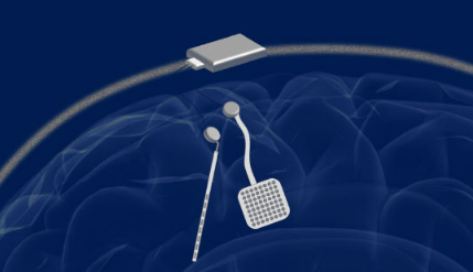 研究人员开发了无线 大脑起搏器