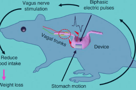 植入式迷走神经刺激装置有助于减肥
