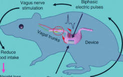 植入式迷走神经刺激装置有助于减肥