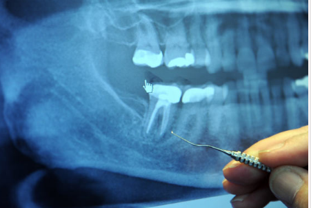 扑热息痛和布洛芬比阿片类药物更有效治疗急性牙痛