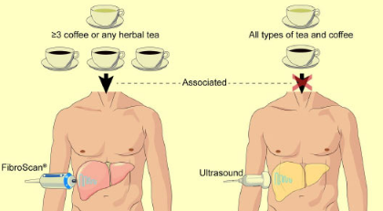 食用咖啡 凉茶可预防肝纤维化