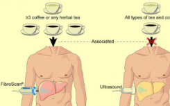 食用咖啡 凉茶可预防肝纤维化