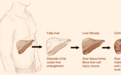 研究人员确定了引起肝纤维化的蛋白
