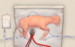 新的类似子宫的设备可能会改变极早婴儿的护理