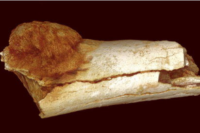 南非化石揭示了人类最早的人癌证据
