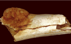 南非化石揭示了人类最早的人癌证据