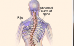 严重脊柱侧弯与必需饮食矿物质锰有关