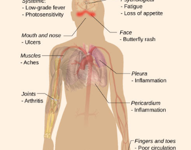 研究人员确定狼疮的潜在病因