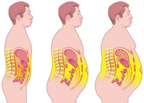 腰部脂肪的堆积比肥胖引起的并发症更为严重