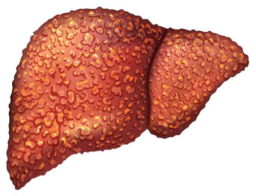 慢性乙型肝炎的治疗与大肠癌和宫颈癌的发病率增加相关