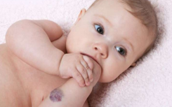 普萘洛尔治疗血管瘤不会损害婴儿的成长