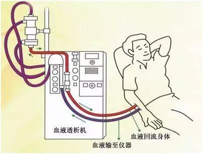 血液透析的历史为有限的医疗资源的道德使用提供了启示