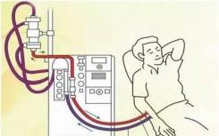 血液透析的历史为有限的医疗资源的道德使用提供了启示