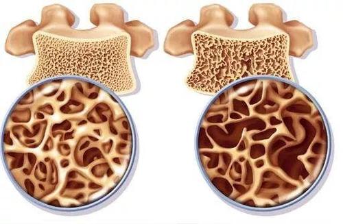 如何处理类固醇诱导的骨质疏松症