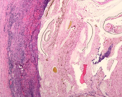 科学家发现过敏与复杂性阑尾炎之间存在联系