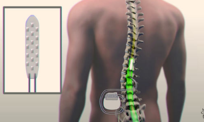 脊柱植入物和物理疗法可帮助瘫痪的人站立和行走