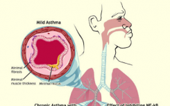 研究人员找到预防急性哮喘症状的新方法