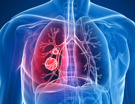 小线圈改善了严重肺气肿患者的生活质量