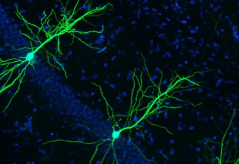 抗癌药候选物可抑制新型阿尔茨海默氏病靶标保护神经元