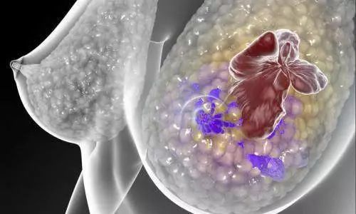 研究人员确定了侵袭性乳腺癌治疗抗性所需的关键蛋白质