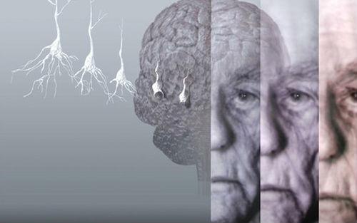 研究可能有助于改善GENUS成为阿尔茨海默氏病的治疗方法