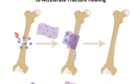 骨绷带吸收修复性生化物质以加速修复