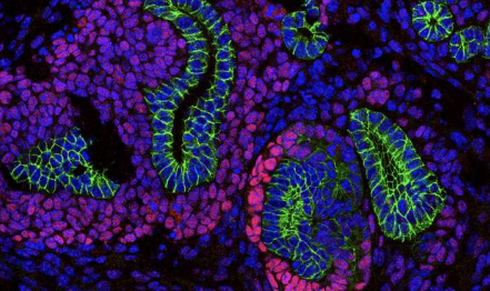 科学家发现儿童肾脏癌的新机制